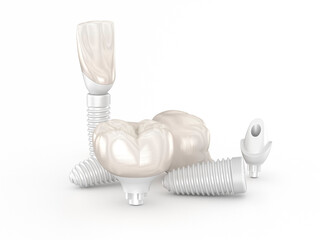 Dental Implants made form ceramic. Dental 3D illustration - 502383133