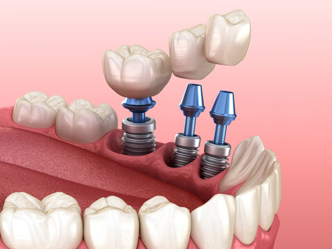 3 tooth crowns placement over 3 implants - concept. Dental 3D illustration