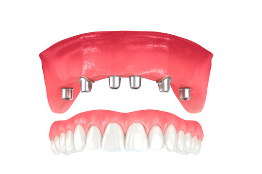 Maxillary prosthesis supported by 2 teeth and 4 implants. Dental 3D illustration