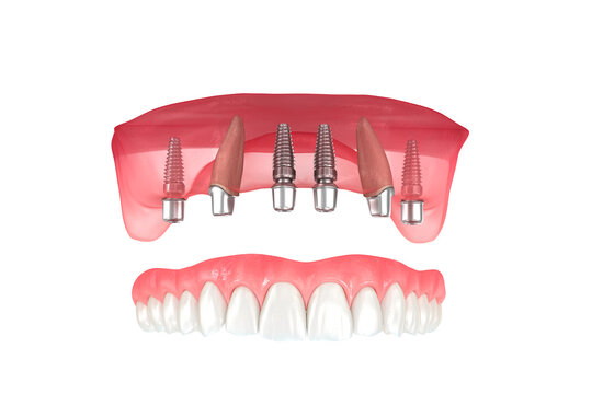 Maxillary prosthesis supported by 2 teeth and 4 implants. Dental 3D illustration