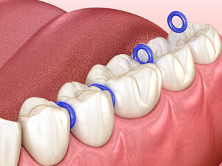 Rubber separator between teeth, preparation for braces placement. Dental 3D illustration