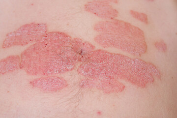 Large red inflamed scaly rash on the stomach.Acute psoriasis on the stomach in a man, severe redness on the skin, an autoimmune incurable dermatological skin disease. Red redness, spots on the skin. - obrazy, fototapety, plakaty