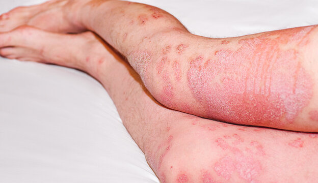 Acute psoriasis, severe reddening of the skin,an autoimmune,incurable dermatological skin disease.Large red,inflamed,scaly rash on man's legs.Joints affected by psoriatic arthritis.