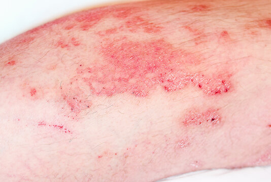 Acute psoriasis, severe reddening of the skin,an autoimmune,incurable dermatological skin disease.Large red,inflamed,scaly rash on man's legs.Red redness,spots on the skin.