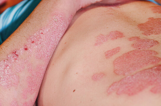 Acute psoriasis in a man, severe redness on the skin, an autoimmune incurable dermatological skin disease.Large red inflamed scaly rash on the body of a man. Red redness, spots on the skin.
