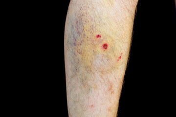 Injured shin, injuries and bruises after a fall