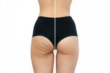 Close-up of female buttocks with cellulite before and after treatment isolated on a white background. Getting rid of excess weight, diet, healthy nutrition, training, sports, massage, scrub. Wellness - obrazy, fototapety, plakaty