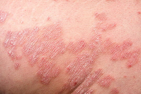Close up part of human skin affected by psoriasis