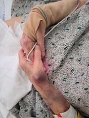 Clasped hands of an elderly woman in a hospital gown with pulse monitor. 