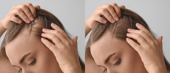 Woman before and after hair loss treatment on grey background, closeup - obrazy, fototapety, plakaty