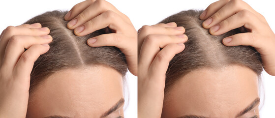 Young woman before and after hair loss treatment on white background, closeup