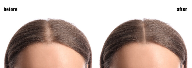 Young woman before and after hair loss treatment on white background, closeup
