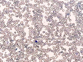 Microscopic view of abnormal reticulocyte count in hematology department, methylene blue staining