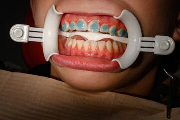 Plastic retractor for lip augmentation in the mouth, dental procedure and retractor as an auxiliary...