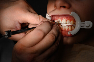 The orthodontist installs braces for the student's boyfriend, visits to the dentist, installation...