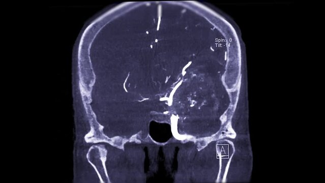 Cerebral angiography  from Fluoroscopy in intervention radiology  showing cerebral artery for diagnosis cerebral artery aneurysm.