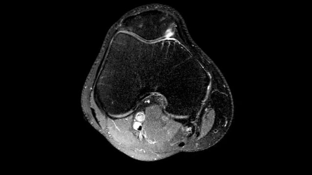 MRI knee joint. Dynamics of scrolling through MRI images. Magnetic resonance imaging of right knee - view from above. Diagnosis sport trauma and damage of ligaments.