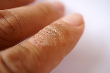 Selective focus of fingers peeling, dry, hard, and chapped on white background. Finger dermatitis, Skin disease.