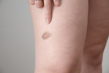 bruise on the girl's leg close-up