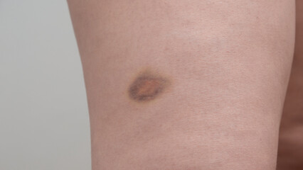 bruise on the girl's leg close-up