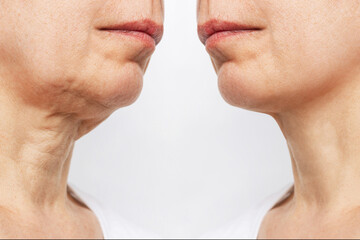 Lower part of face and neck of elderly woman with signs of skin aging before and after facelift, plastic surgery isolated on white background. Age-related changes, flabby sagging skin. Platysmoplasty - obrazy, fototapety, plakaty