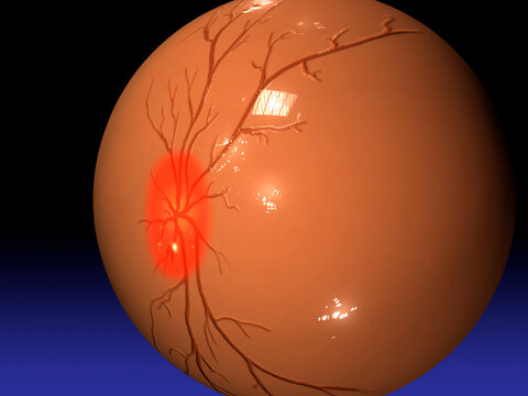 Close-up of the human eyeball with retinal damage caused by glaucoma