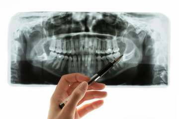 Close-up of panoramic dental scan. Radiologist hand points to problem area on X-ray. - obrazy, fototapety, plakaty