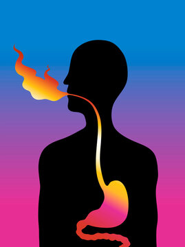 Reflux, illustration