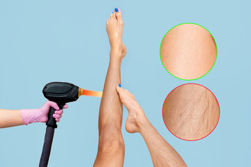 Woman lifted her haired legs apart. Two area with results before and after hair removal procedure....