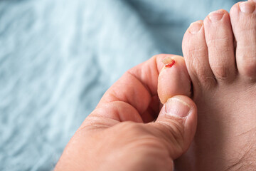 Nail of the little toe, broken and bloody.