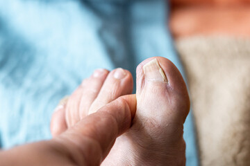 Hallux toe nail, partially broken and ingrown