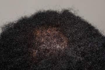 Hair loss on afro-american head scalp