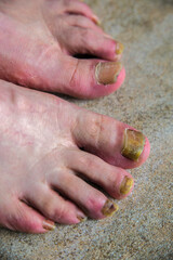 Onychomycosis with fungal nail infection two feet