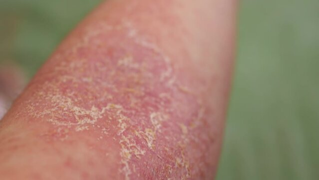 Close-up view of the eczema on a person's arm.