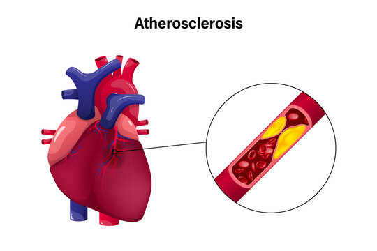 Atherosclerosis with heart vector concept. Coronary Artery Disease. Causes of myocardial ischemia.