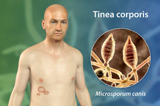 Tinea Corporis Images – Browse 280 Stock Photos, Vectors, and Video