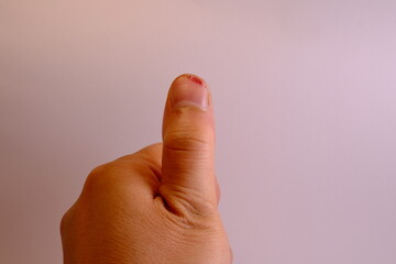Thumb was cut off with a knife. close-up of a wound.