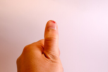 Thumb was cut off with a knife. close-up of a wound.