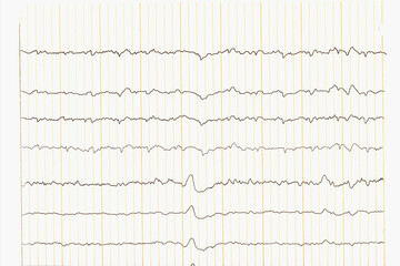 Sinus Heart Rhythm on paper for recording an electrocardiogram. EKG test