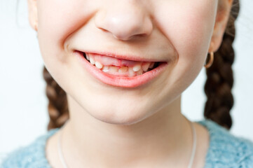 Fototapeta premium In the child's mouth, two upper front milk teeth were torn out.