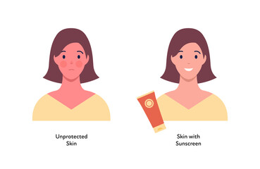 Summer skin care and sunscreen protection concept. Vector flat people illustration. Compare of woman with unprotected skin tan and protected with cream. Design for beauty industry and healthcare