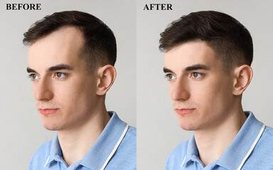 Young man before and after hair loss treatment on light background