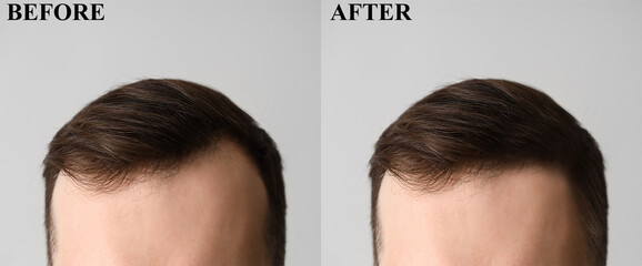 Young man before and after hair loss treatment on light background, closeup