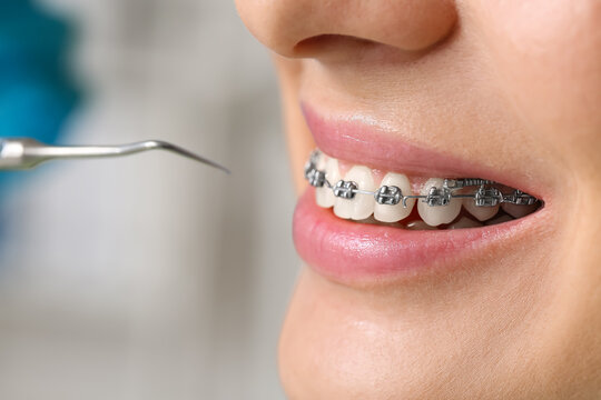 Woman with dental braces visiting dentist in clinic, closeup