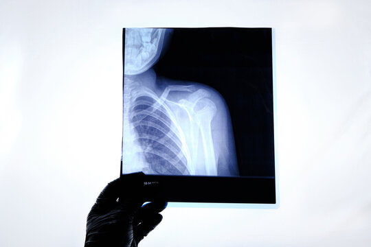 X-ray image of a man with a broken collarbone.