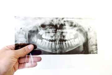 The dentist holds in his hand a panoramic x-ray of the teeth or an orthopantomogram, detailed radiographic examination of the jaw, which gives comprehensive information about all teeth. © Andriy