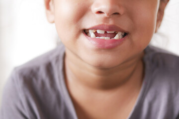 child girl smiling with deformed teeth 