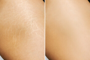 Close up of a young woman's thigh with white stretch marks from a weight loss or weight gain before...