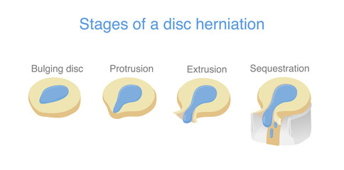 4 Stage of disc herniation. Medical diagram about spine problems that make back and neck pain.