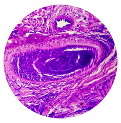 Skin Cancer: Skin biopsy under microscope showing Basal cell carcinoma.